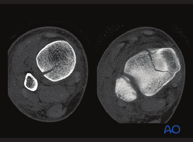 CT images on the level of the metaphysis and epiphysis showing a triplane fracture of the pediatric distal tibia