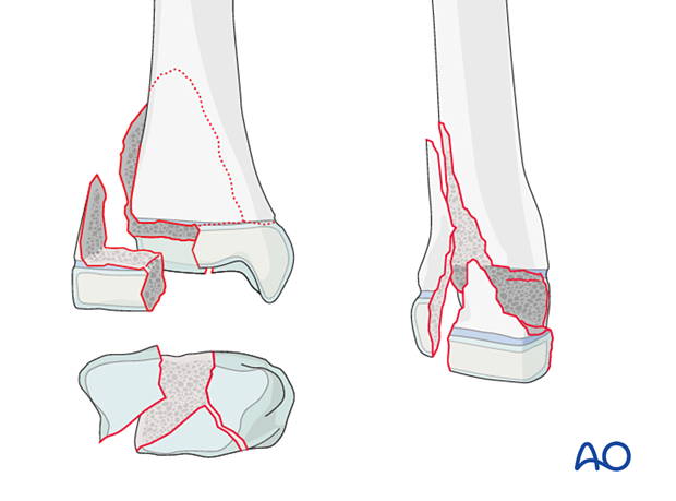 Triplane fracture of the pediatric distal tibia