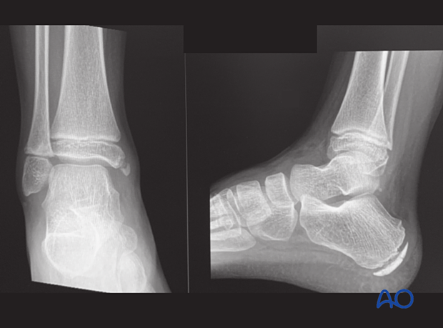 X-rays showing an avulsion of the medial malleolus in a 7-year-old patient