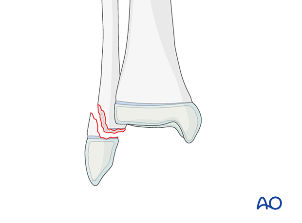 Salter-Harris II fracture of the pediatric distal fibula