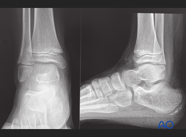 X-rays showing a Salter-Harris II fracture of the fibula in a 9-year-old patient