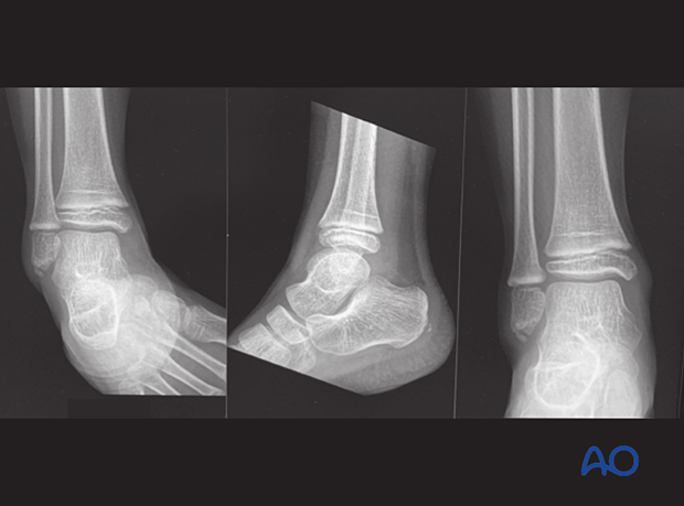 X-rays showing an avulsion of the fibular malleolus in a 6-year-old patient