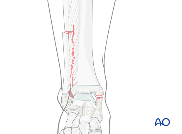 Syndesmotic injury in the pediatric distal tibia and fibula 