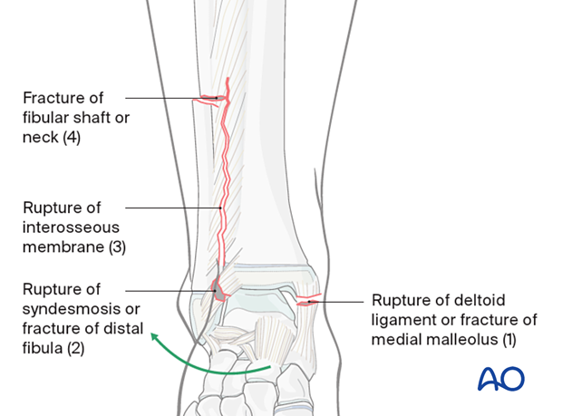 Syndesmotic injury in the pediatric distal tibia and fibula
