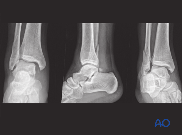 X-rays showing a syndesmotic injury with an associated metaphyseal fracture of the fibula in a 14-year-old patient