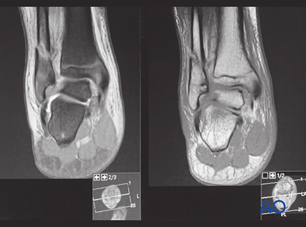 MRI of a syndesmotic injury with an associated metaphyseal fracture of the fibula in a 14-year-old patient