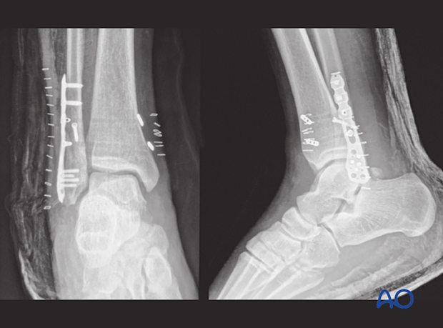 X-rays showing the suture fixation of a syndesmotic injury and plate fixation of the associated metaphyseal fibular fracture in a 14-year-old patient