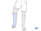 Short leg cast for immobilization of the ankle 