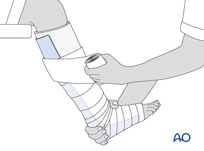 Short leg cast for Epiphysiolysis (Salter-Harris I) of the distal tibia