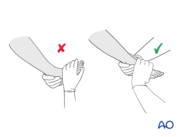 Placing the foot and ankle in a neutral position may produce an apex posterior deformity in unstable fractures.