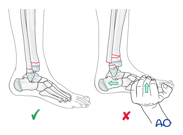 Placing the foot and ankle in a neutral position may produce an apex posterior deformity in unstable fractures