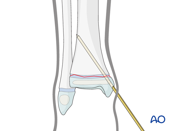 Insertion of first K-wire for closed reduction and K-wire fixation of a Salter-Harris I fracture of the distal tibia