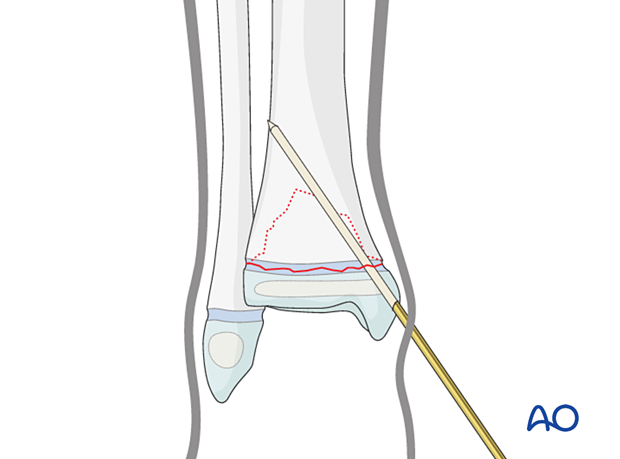 Insertion of first K-wire for closed reduction and K-wire fixation of a Salter-Harris II fracture of the distal tibia