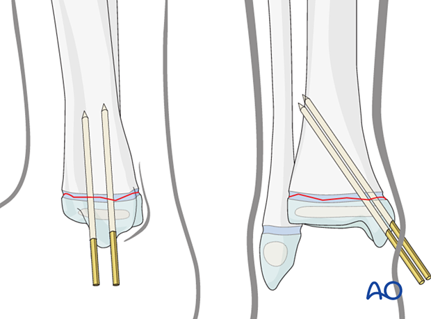 Insertion of second K-wire for closed reduction and K-wire fixation of a Salter-Harris I fracture of the distal tibia