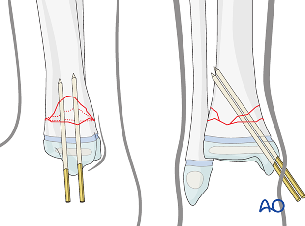Insertion of second K-wire for closed reduction and K-wire fixation of a multifragmentary metaphyseal fracture of the distal tibia