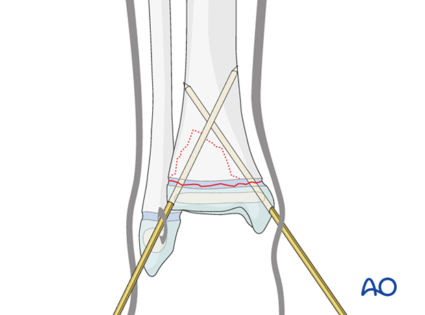 Insertion of second K-wire for closed reduction and K-wire fixation of a Salter-Harris II fracture of the distal tibia