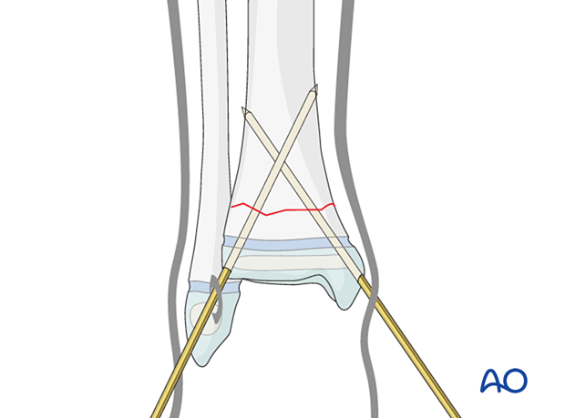Insertion of second K-wire for closed reduction and K-wire fixation of a simple metaphyseal fracture of the distal tibia