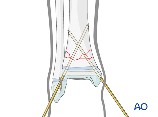 Insertion of second K-wire for closed reduction and K-wire fixation of a multifragmentary metaphyseal fracture of the distal tibia