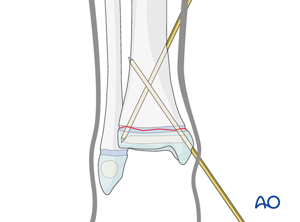 Insertion of second K-wire for closed reduction and K-wire fixation of a Salter-Harris I fracture of the distal tibia