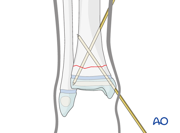 Insertion of second K-wire for closed reduction and K-wire fixation of a simple metaphyseal fracture of the distal tibia