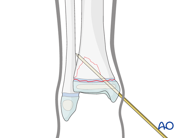 Insertion of K-wire for closed reduction and K-wire fixation of a Salter-Harris II fracture of the distal tibia