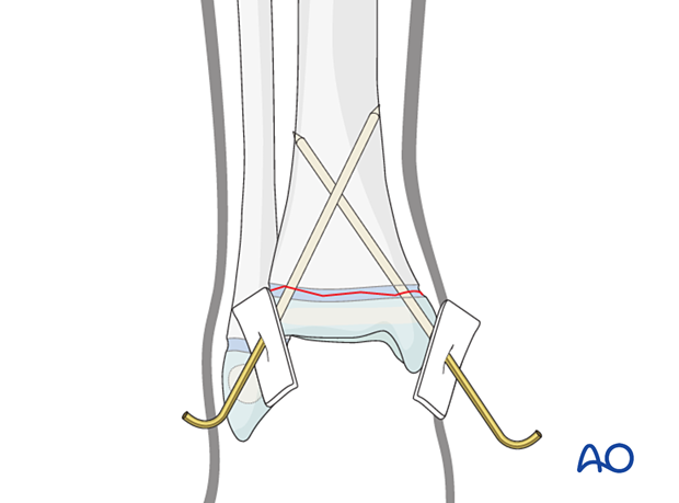 Closed reduction and K-wire fixation of a Salter-Harris I fracture of the distal tibia