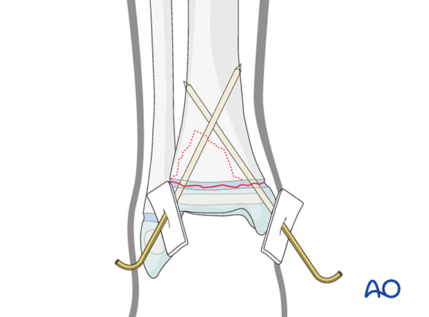 Closed reduction and K-wire fixation of a Salter-Harris II fracture of the distal tibia