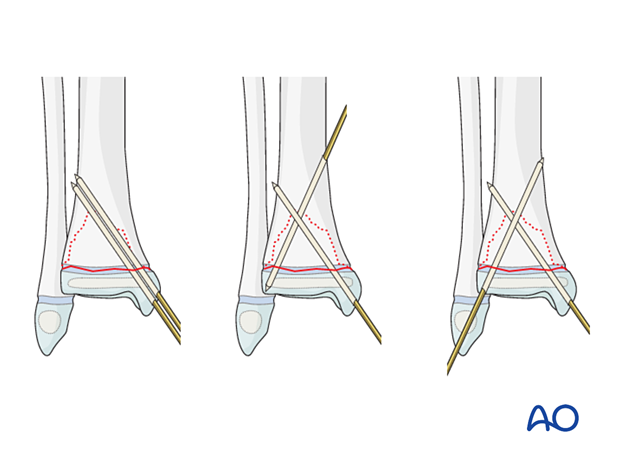 Closed reduction and K-wire fixation of a Salter-Harris II fracture of the distal tibia