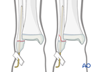 Closed reduction and K-wire fixation of a Salter-Harris I and II fracture of the distal fibula