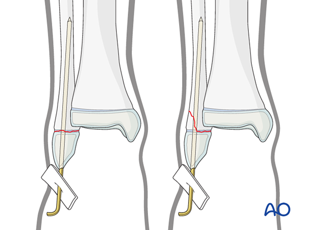 distal fibula