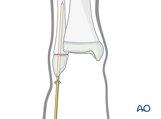 Insertion of a K-wire for closed reduction and K-wire fixation of a Salter-Harris I fracture of the distal fibula