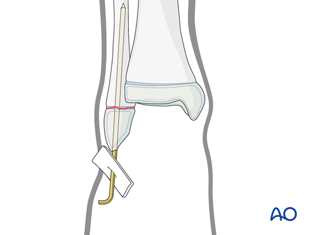 Closed reduction and K-wire fixation of a Salter-Harris I fracture of the distal fibula