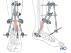 Joint-spanning external fixation with a triangular construct