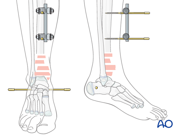 Tibial frame construction for triangular external fixation