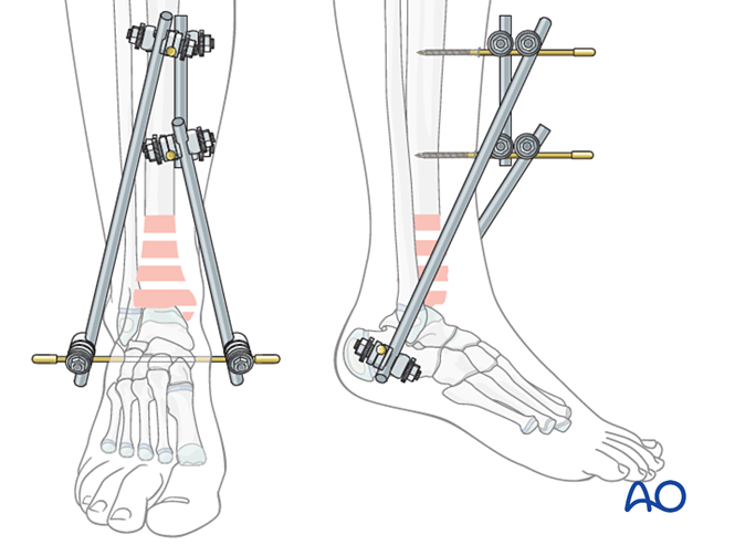 External fixation for Complex epi-/metaphyseal fractures of the distal ...