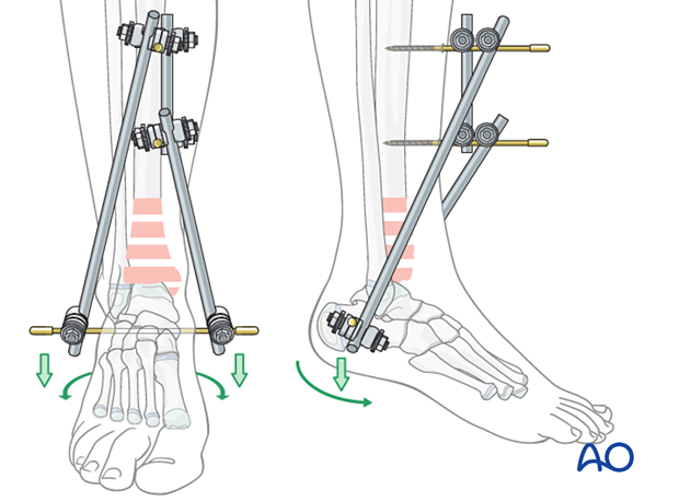 Tibial fracture reduction with triangular external fixation