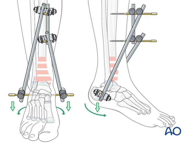 External Fixation For Complex Epi Metaphyseal Fractures Of The Distal