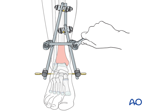 Rod connection for stabilization of tibial triangular external fixation