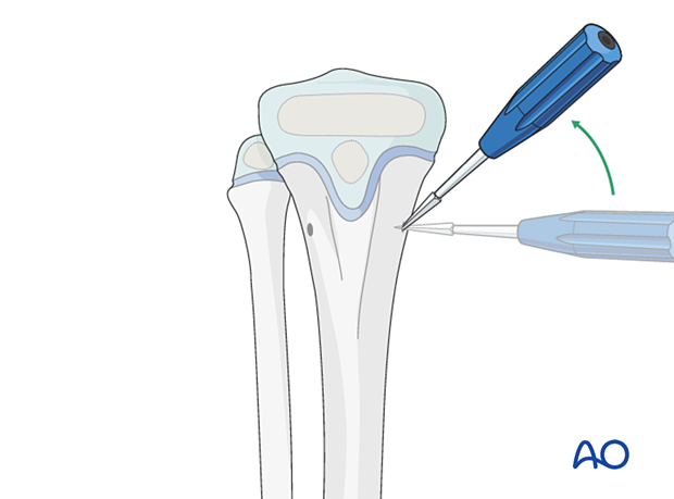 Opening the entry points for elastic nailing of distal tibial fractures