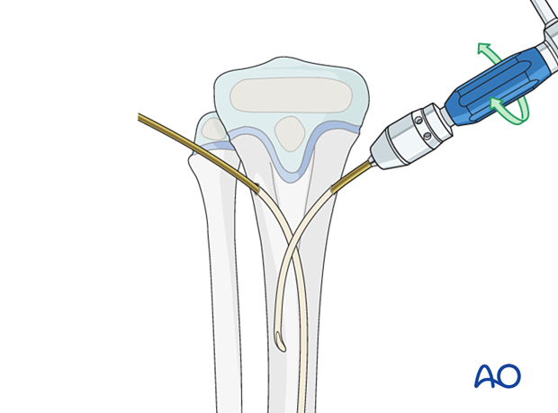 Nail insertion for elastic nailing of distal tibial fractures