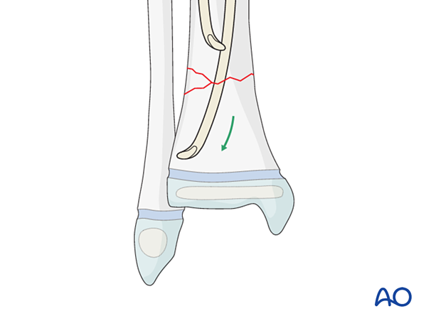 Advancing the elastic nails past the fracture site in the distal tibia