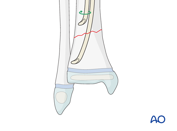 Rotating the nail tip towards the center of the bone for better advancement across the fracture in the distal tibia