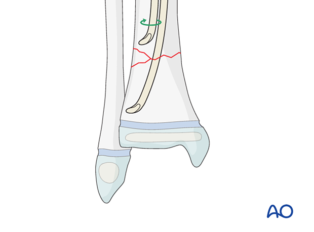 Rotating the nail tip towards the center of the bone for better advancement across the fracture in the distal tibia
