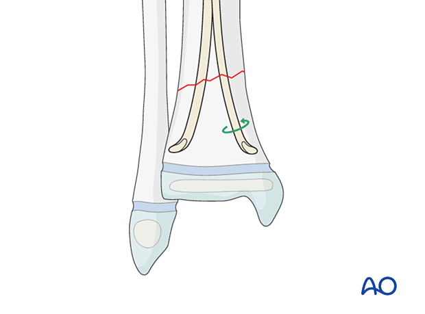 Redirecting the nail tip in elastic nailing of distal tibial fractures