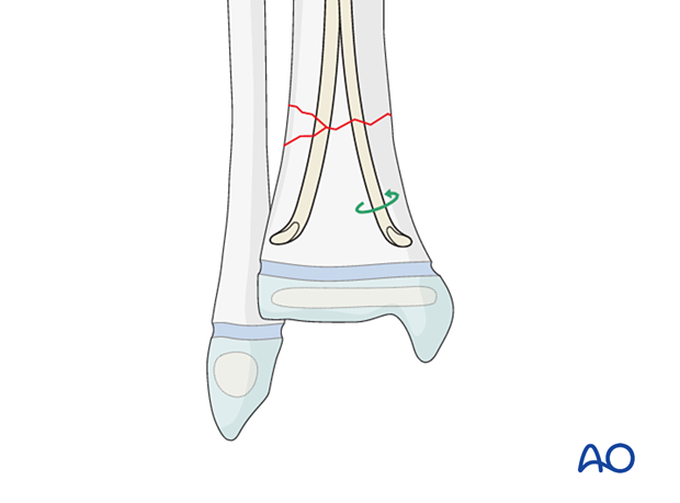 Redirecting the nail tip in elastic nailing of distal tibial fractures