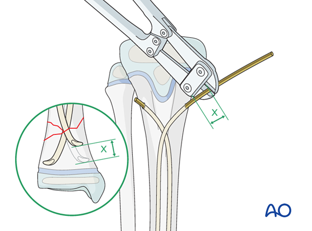 Cutting the nails with a cutter for elastic nailing of distal tibial fractures