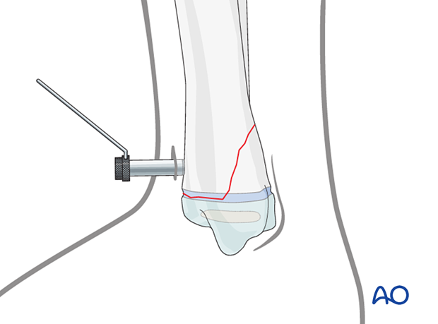 Inserting a soft-tissue protector for screw fixation of a Salter-Harris II fracture of the distal tibia