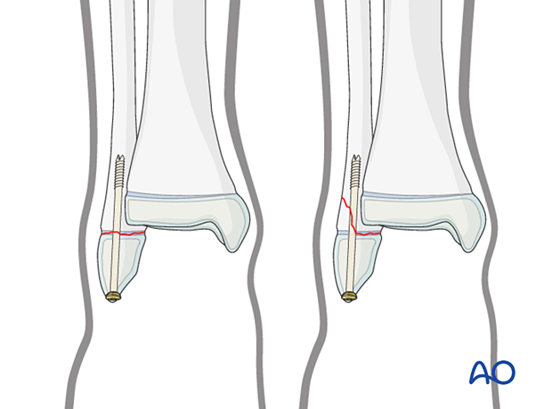 Closed reduction and screw fixation of a Salter-Harris I and II fracture of the distal fibula