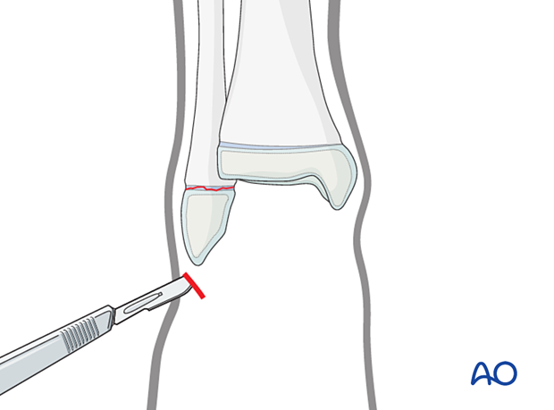 Incision for screw fixation of a distal fibular fracture