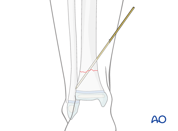 Temporary K-wire stabilization of a metaphyseal fracture of the distal tibia
